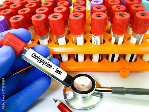 Blood sample in test tuber for Chymotrypsin test. Fecal Chymotrypsin test, pancreatic insufficiency photo