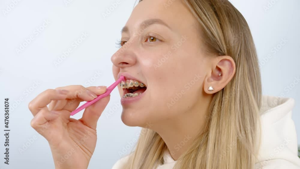 Healthcare hygiene. Cleaning braces teeth system, close-up. Oral care concept with braces. Woman brushing metal brackets by orthodontic toothbrushes, dental floss, monobuched brush. Healthcare hygiene. Cleaning braces teeth system, close-up. Oral care concept with braces. Woman brushing metal brackets by orthodontic toothbrushes, dental floss, monobuched brush.