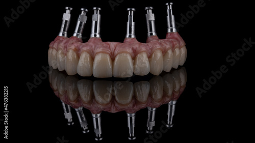 Dental implants and dentures in close-up Siemke on a black background	
