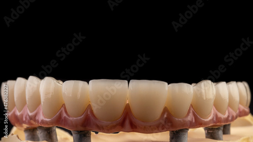Dental implants and dentures in close-up Siemke on a black background	
