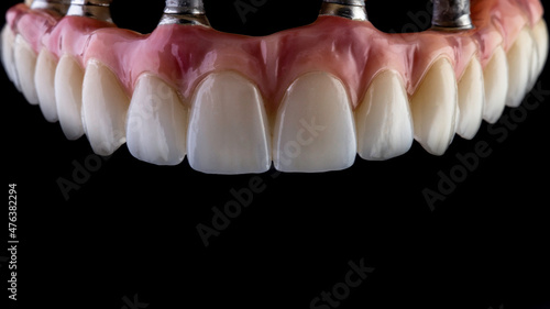 Dental implants and dentures in close-up Siemke on a black background	
