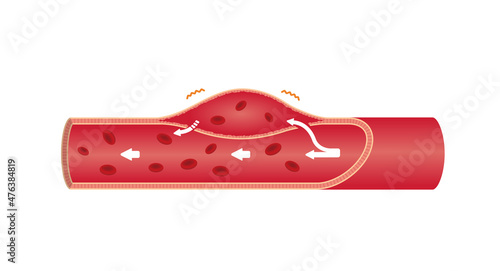 Vector illustration of aortic dissection (no text)
