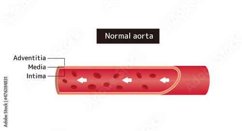 Vestor  illustration of normal aorta