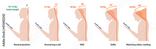 Computer neck syndrome