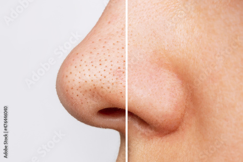 Close-up of woman's nose with blackheads or black dots before and after peeling, cleansing the face isolated on a white background. Acne problem, comedones. Profile. Cosmetology dermatology concept photo