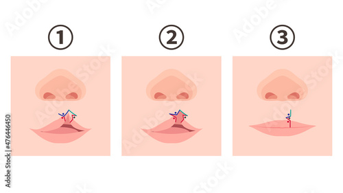 口唇口蓋裂_口唇裂の手術方法のイラスト_三角弁法