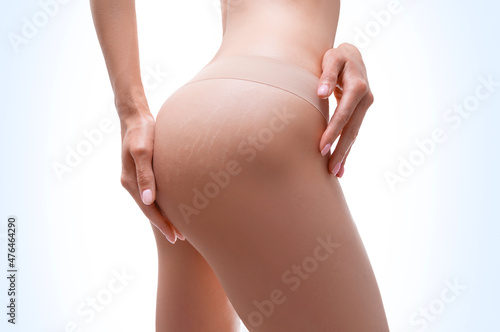 Image of female thighs with stretch marks on the skin. Laser correction.