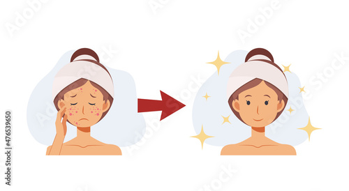 treat acne,skin problem,pimple .woman face.Beautyful. Flat vector 2d cartoon character illustration. Before, after