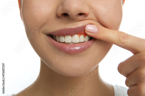 Young woman showing inflamed gums, closeup view photo