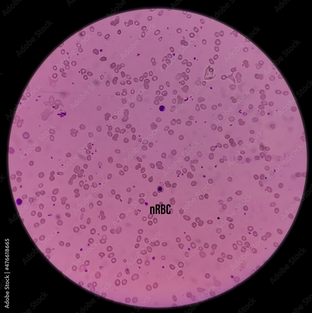 Leishman's stain microscopic show Leucoerythroblastic anemia with