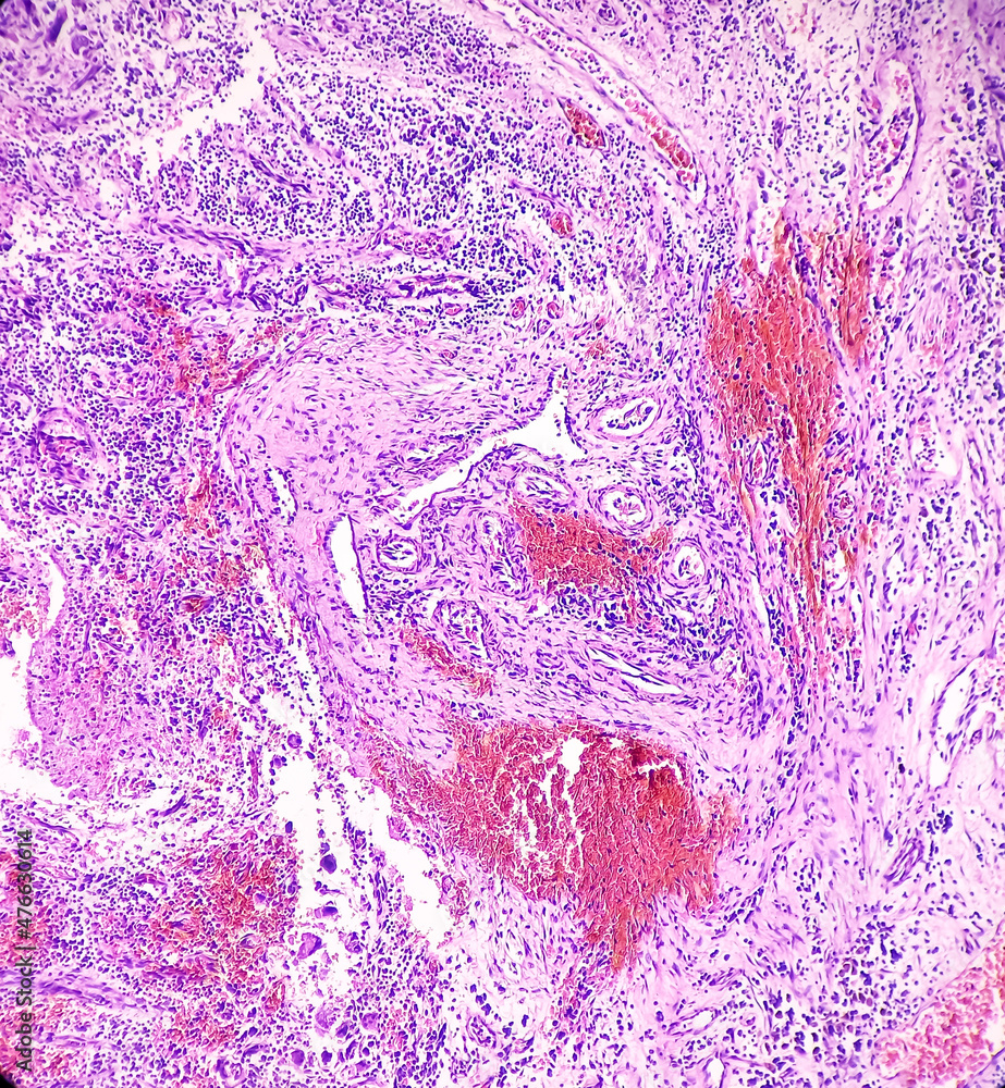 Ear and mastoid(biopsy) Microphotograph of Cholesteatoma, show