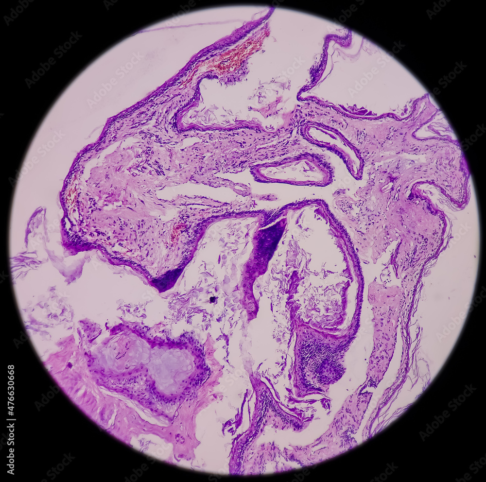 Ear and mastoid(biopsy) Microphotograph of Cholesteatoma, show