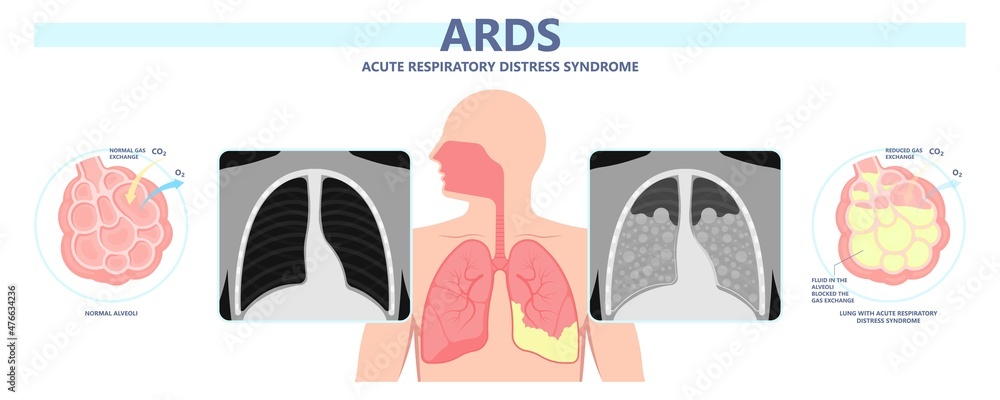 Acute respiratory distress syndrome (ARDS) a respiratory failure and inflammation in the lungs equipment hospital Emphysema fibrosis idiopathic Cystic Collapsed pneumothorax embolism X-Ray chest ICU - obrazy, fototapety, plakaty 