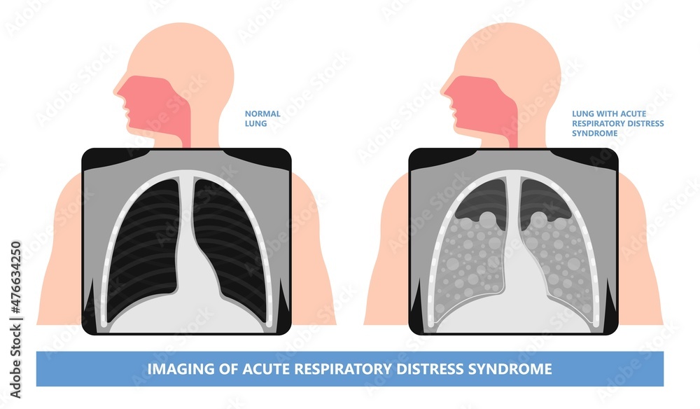 Acute respiratory distress syndrome (ARDS) a respiratory failure and inflammation in the lungs equipment hospital Emphysema fibrosis idiopathic Cystic Collapsed pneumothorax embolism X-Ray chest ICU - obrazy, fototapety, plakaty 