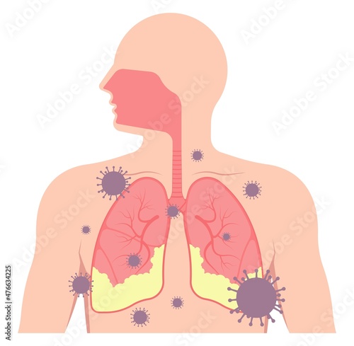 Acute respiratory distress syndrome (ARDS) a respiratory failure and inflammation in the lungs equipment hospital Emphysema fibrosis idiopathic Cystic Collapsed pneumothorax embolism X-Ray chest ICU photo