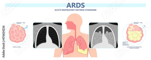 Acute respiratory distress syndrome (ARDS) a respiratory failure and inflammation in the lungs equipment hospital Emphysema fibrosis idiopathic Cystic Collapsed pneumothorax embolism X-Ray chest ICU