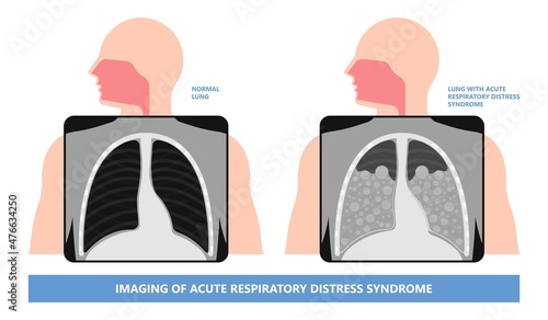 Acute respiratory distress syndrome (ARDS) a respiratory failure and inflammation in the lungs equipment hospital Emphysema fibrosis idiopathic Cystic Collapsed pneumothorax embolism X-Ray chest ICU