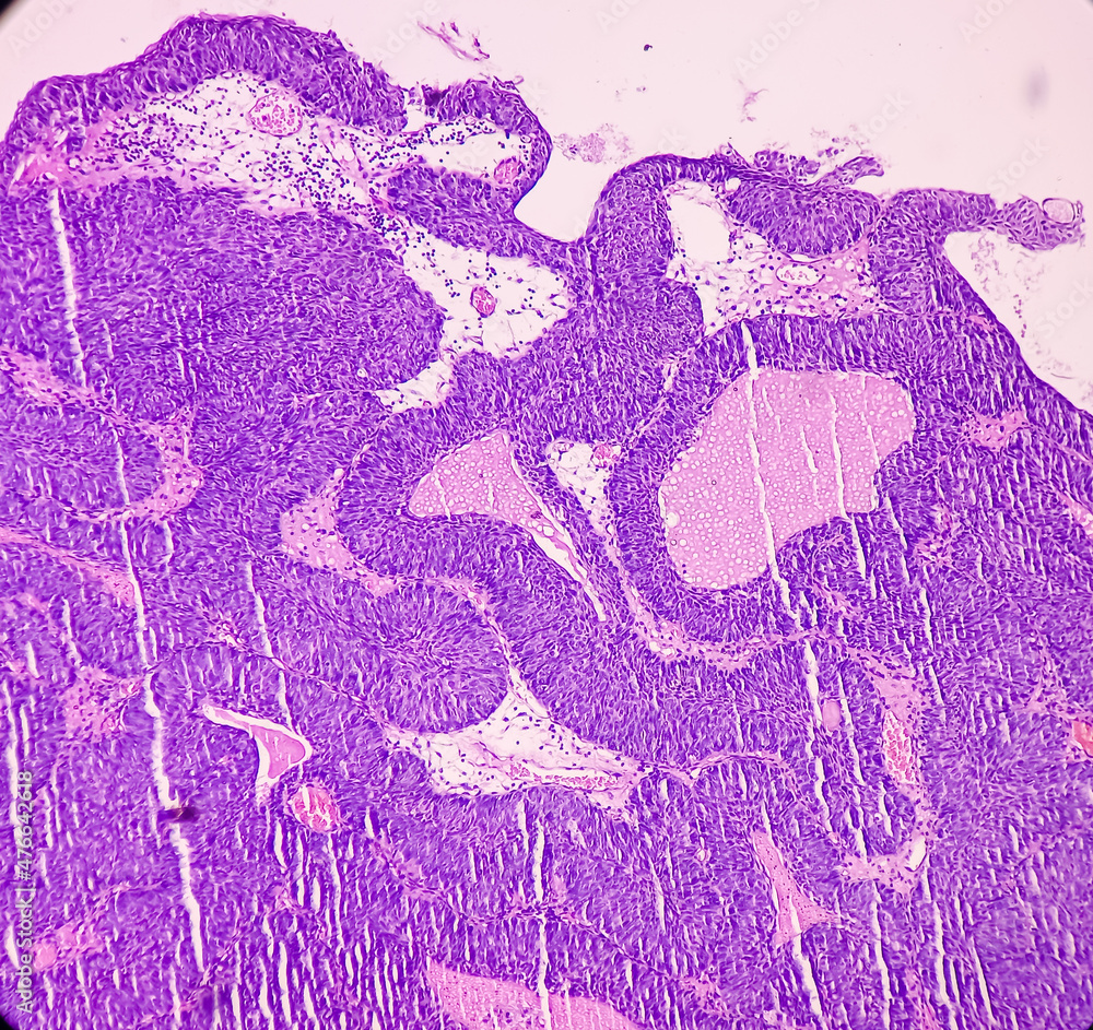 malignant neoplasm of bladder