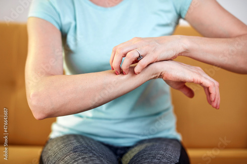 Woman with itchy, tingling arms scratching skin. photo