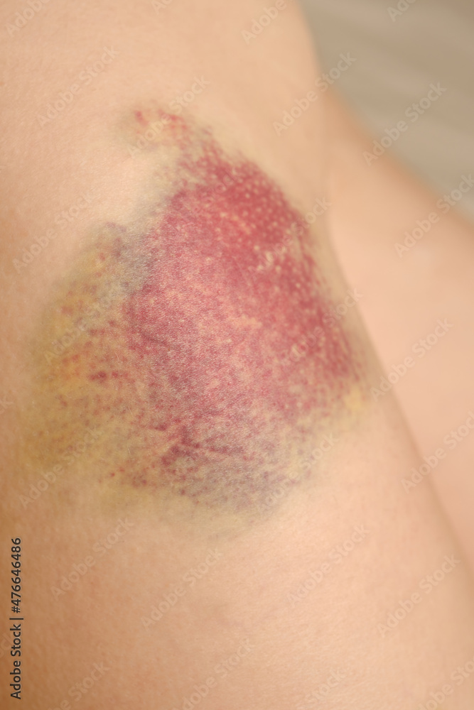 Big bruise on the leg. Big bruise on the leg. The concept of violence, sports trauma and various bruises or domestic violence, Selective focus Big bruise on the leg. Big bruise on the leg. The concept of violence, sports trauma and various bruises or domestic violence, Selective focus