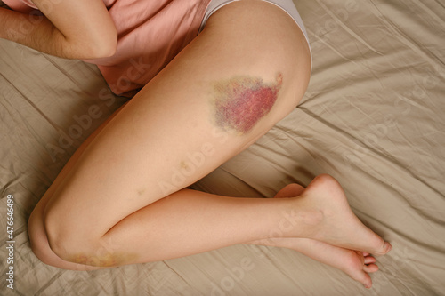 Fototapeta Naklejka Na Ścianę i Meble -  Big bruise on the leg. Big bruise on the leg.  The concept of violence, sports trauma and various bruises or domestic violence, Selective focus