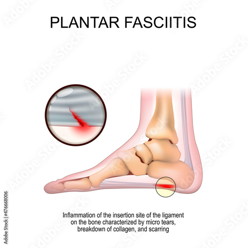 Plantar fasciitis. foot anatomy photo