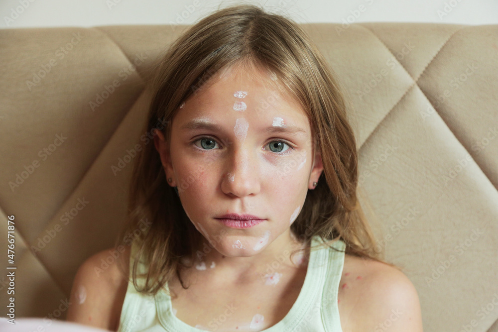 Cute little girl with chickenpox at home. Varicella zoster virus. Cute little girl with chickenpox at home. Varicella zoster virus.