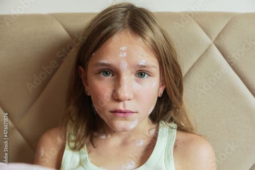 Obraz na plátně Cute little girl with chickenpox at home. Varicella zoster virus.