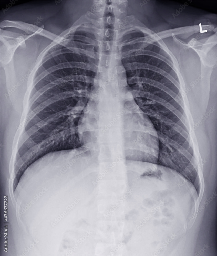 A photo of plain radiograph on dark background in hospital. The film use for diagnosis the illness of patient.Medical concept. A man with normal chest x-ray. A photo of plain radiograph on dark background in hospital. The film use for diagnosis the illness of patient.Medical concept. A man with normal chest x-ray.