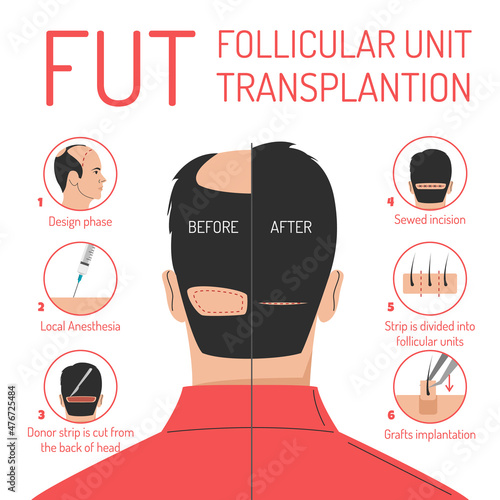 FUT hair transplantation process vector isolated. Follicular unit transplantation. Baldness problem, surgical treatment. Graft implantation, medical infographic.