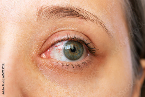 Close-up of female eye with red inflamed and dilated capillaries. Hemorrhage under the conjunctiva. Burst vessel. Conjunctivitis, keratitis, dry eye syndrome, trauma, uveitis photo