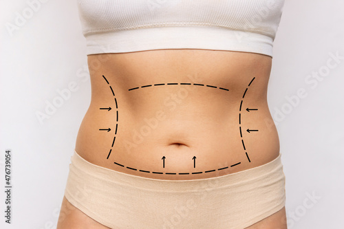 Close-up of a woman's belly with excess fat with marking on her body isolated on a white background. Overweight, flabby and sagging stomach. Liposuction, plastic surgery concept