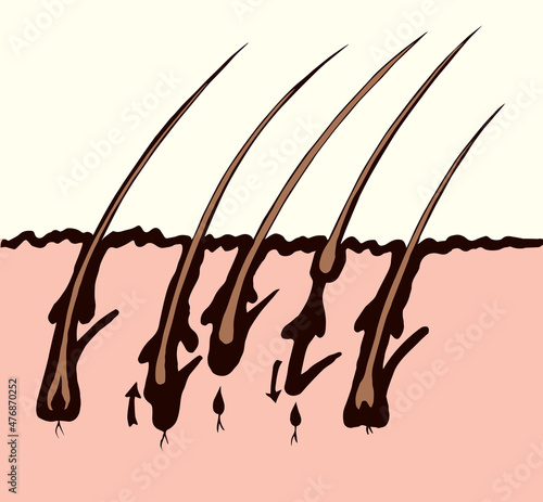 Hair growth draft. Vector drawing