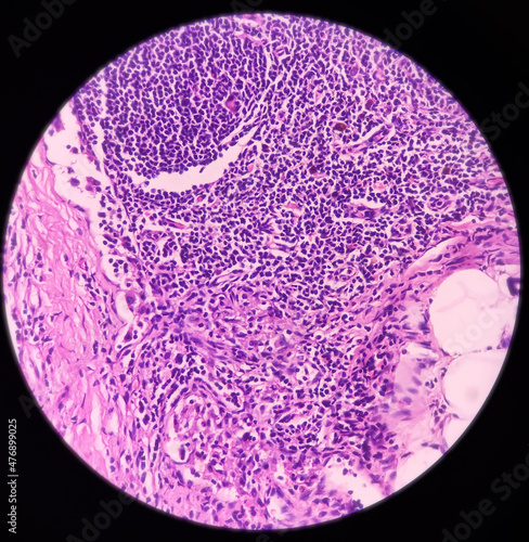 Parotid tumor: Pleomorphic adenoma, benign neoplasm, composed of epithelial and mesenchymal tissues. Background chondro myxoid. No malignancy seen. photo