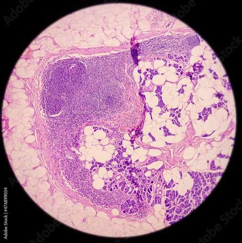 Parotid tumor: Pleomorphic adenoma, benign neoplasm, composed of epithelial and mesenchymal tissues. Background chondro myxoid. No malignancy seen. photo