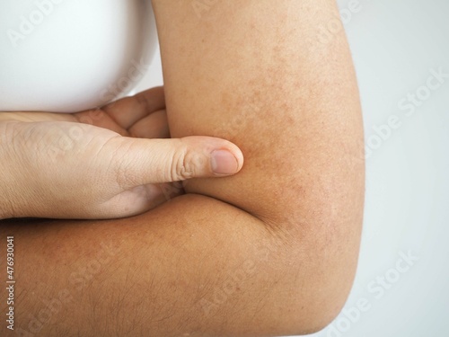 Asian woman had dark brow birthmarks on her arms near her elbows. closeup photo, blurred. photo