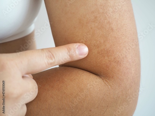 Asian woman had dark brow birthmarks on her arms near her elbows. closeup photo, blurred.