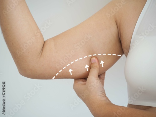 Asian woman grabbing skin on her upper arm with the drawing arrows, Lose weight and liposuction cellulite removal concept, on white background. closeup photo, blurred. photo