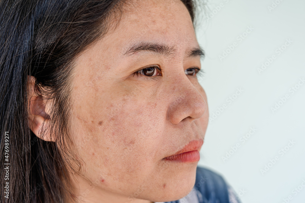 Obraz premium Close up of Asian adult woman face has freckles, large pores, blackhead pimple and scars problem from not take care for a long time. Soft focus of skin problem face. Treatment and Skincare concept
