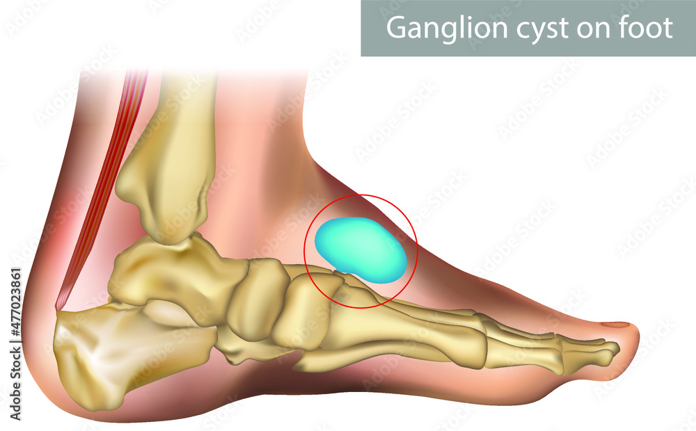 Vecteur Stock Medical vector illustration of ganglion foot cyst with bones.  Big ganglion cysts,a sac of jelly like fluid,is on the foot of man put on  the white background. | Adobe Stock