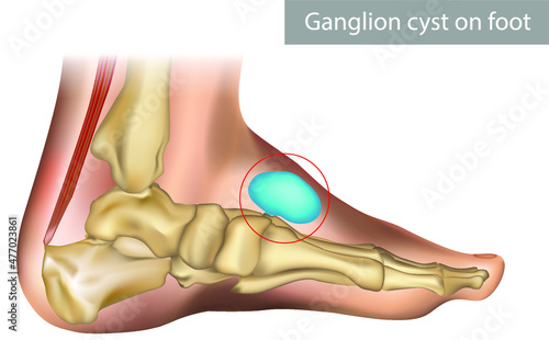 Medical vector illustration of ganglion foot cyst with bones. Big ganglion cysts,a sac of jelly like fluid,is on the foot of man put on the white background.
