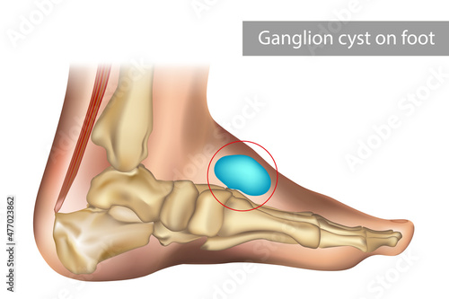 Medical vector illustration of ganglion foot cyst with bones. Big ganglion cysts,a sac of jelly like fluid,is on the foot of man put photo