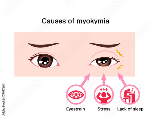 Causes of myokymia (eyelid twitch or tic) vector illustration