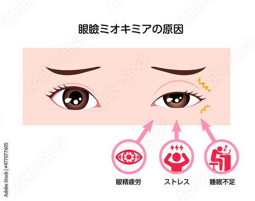 眼瞼ミオキミア（瞼のピクピクした痙攣) の原因 ベクターイラスト