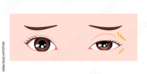 Causes of myokymia (eyelid twitch or tic) vector illustration