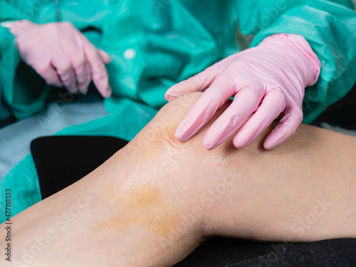 Doctor s hands apply medicinal ointment to the bruise on the patient s leg. Pain  hematoma  first aid for knee trauma.