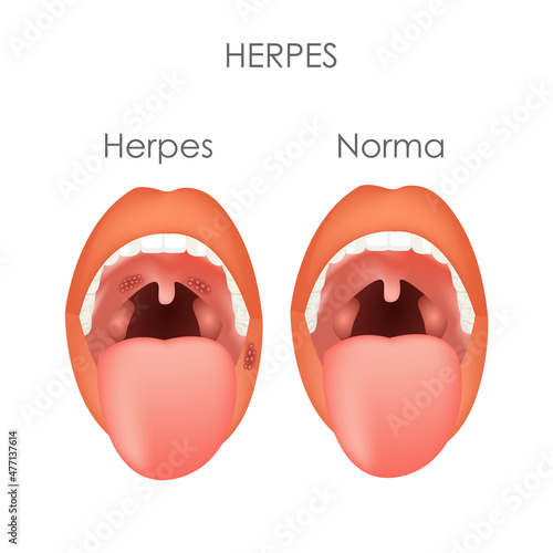 Herpes. Norm and disease. Throat structure. Vector