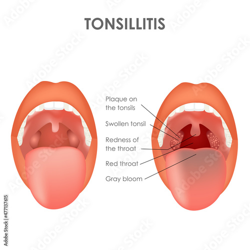 Tonsillitis. Norm and disease. Throat structure. Vector
