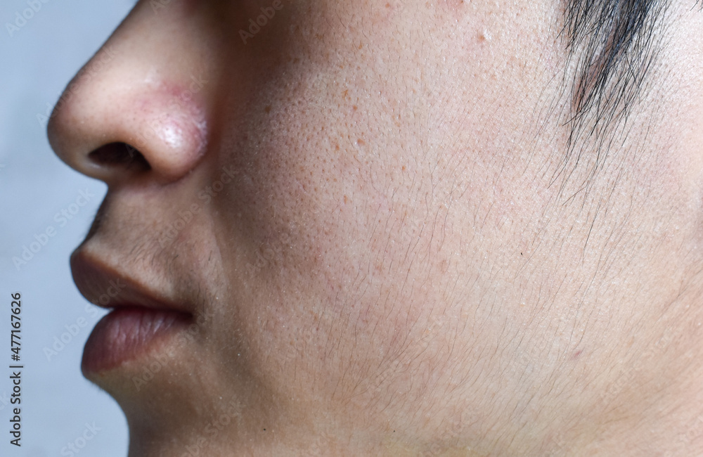 Fototapeta premium Fair skin with wide pores in hairy face of Asian, Myanmar or Korean man.