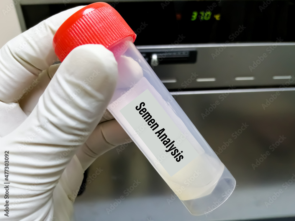 Semen in a pot for analysis at the doctor's hand. Human fertility diagnosis sperms count microscopic. Semen analysis Semen in a pot for analysis at the doctor's hand. Human fertility diagnosis sperms count microscopic. Semen analysis